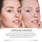 Retinol Acne Treatment Oil - Repair & Clear Skin Serum